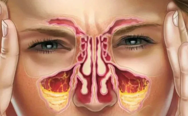 Tăng tiết chất nhầy - Phản ứng "tự vệ" của cơ thể